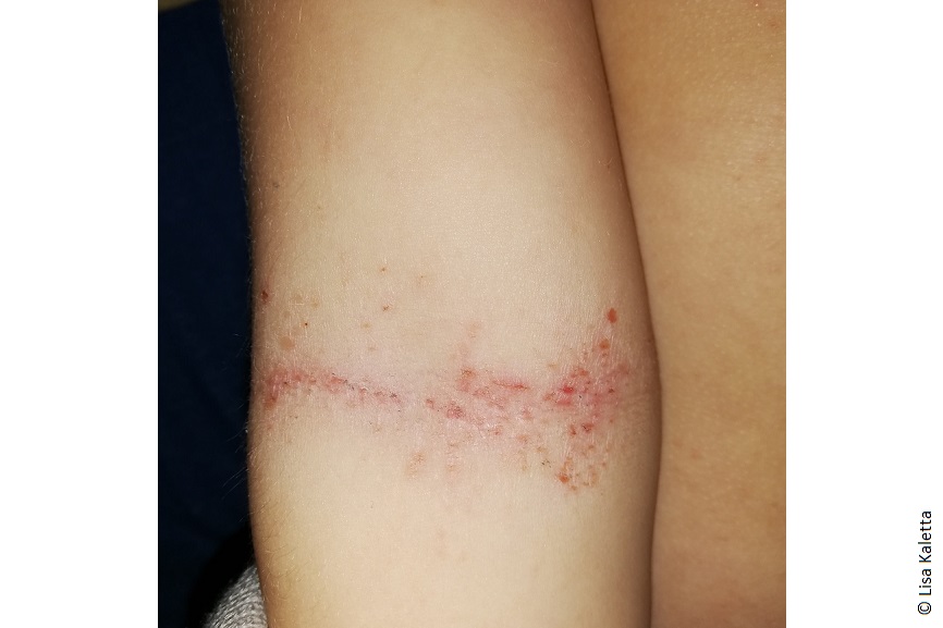 Ein Foto von Lisas Armbeuge. Es sind rote Flecken und Pusteln zu erkennen. 